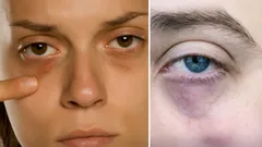 Donkere kringen onder de ogen? Experts benoemen de belangrijkste oorzaken en oplossingen